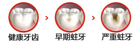 常熟蛀牙补牙用什么材料好？