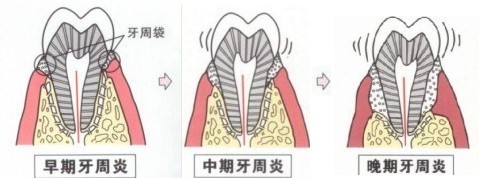 常熟老年人得了牙周炎怎么办