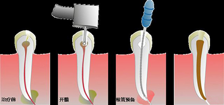 根管治疗一共几个阶段,要去几次
